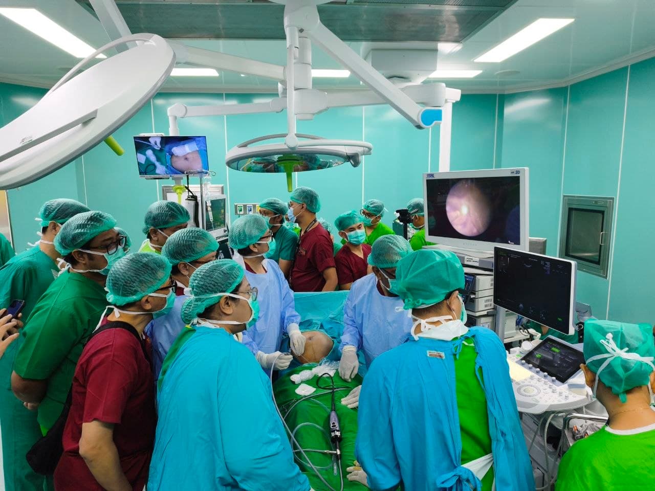 RSUP Ngoerah Kembali Laksanakan Laser Fetoscopy untuk Kasus Twin-to-Twin Transfusion Syndrome